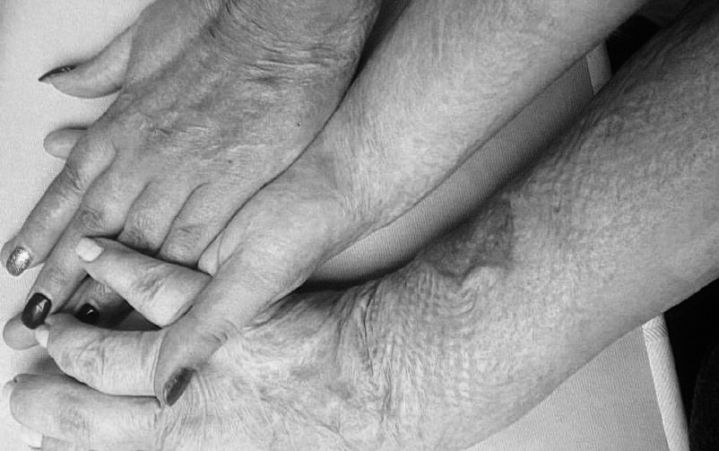 Hender med brannskade